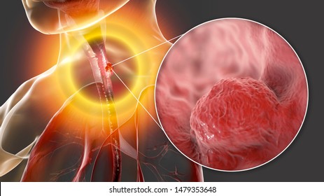 Esophageal Cancer, 3D Illustration Showing Malignant Tumor In The Human Esophagus