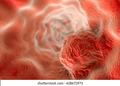 Esophageal Cancer, 3D Illustration Showing Tumor On The Wall Of Esophagus