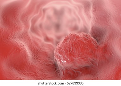 Esophageal Cancer, 3D Illustration Showing Tumor On The Wall Of Esophagus