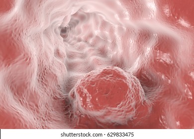 Esophageal Cancer, 3D Illustration Showing Tumor On The Wall Of Esophagus