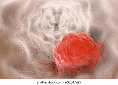 Esophageal Cancer, 3D Illustration Showing Tumor On The Wall Of Esophagus