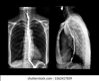 Esophagram Or Barium Swallow AP And Lateral View Is An X-ray Of The Esophagus ,The Patient Drinks A Liquid That Contains Barium .The Liquid Coats The Esophagus And X-rays Are Taken.