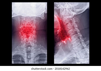 Esophagram Or Barium Swallow AP And Lateral View  Showing Esophagus For Diagnosis GERD Or Gastroesophageal Reflux Disease And Esophageal Cancer.