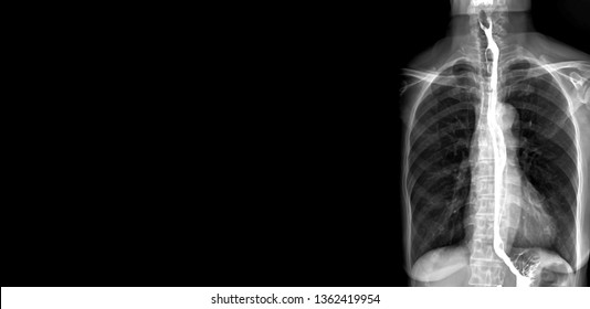 Esophagram Or Barium Swallow AP View Is An X-ray Of The Esophagus ,The Patient Drinks A Liquid That Contains Barium .The Liquid Coats The Esophagus And X-rays Are Taken For Finding Cancer.