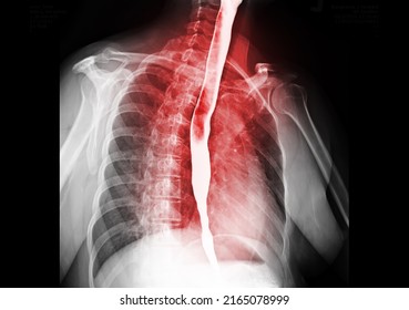 Esophagram Or Barium Swallow  Showing Esophagus For Diagnosis GERD Or Gastroesophageal Reflux Disease Or Esophageal Cancer.