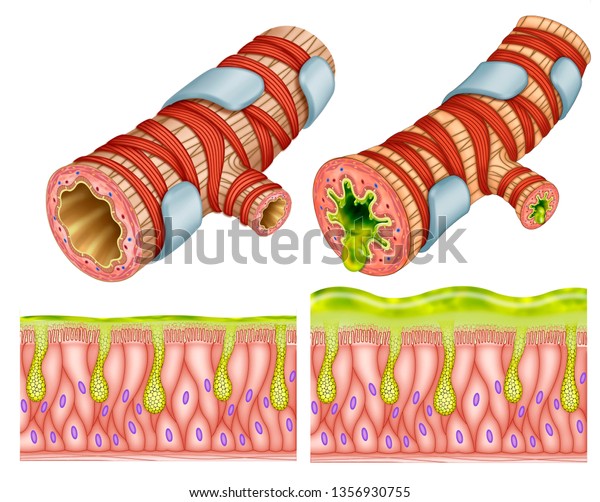 Examples Two Segments Bronchial Tubes One Stock Illustration 1356930755