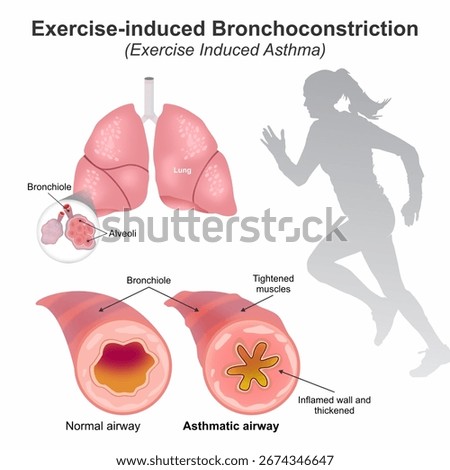 Exercise-induced bronchoconstriction (Exercise Induced Asthma)
