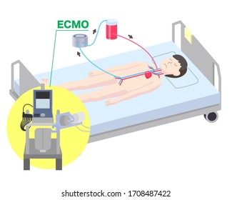 Extracorporeal Membrane Oxygenator Illustration Ecmo Stock Illustration ...