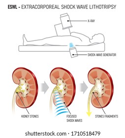 Extracorporeal shock wave lithotripsy (ESWL) for kidney stones. shock waves to break a kidney stone.