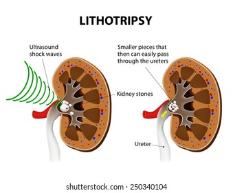 Extracorporeal shock wave lithotripsy (ESWL) for kidney stones. shock waves to break a kidney stone into small pieces that can more easily travel through the urinary tract  and pass from the body