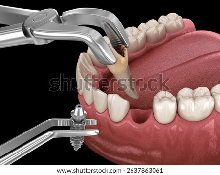 Extraction and Implantation, complex immediate surgery. Medically accurate 3D illustration of dental treatment