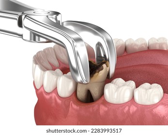 Extraction of Molar tooth damaged by caries. Dental 3D illustration