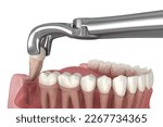 Extraction of wisdom tooth. Medically accurate tooth 3D illustration.