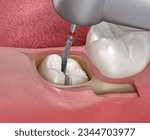 Extraction of wisdom tooth. Medically accurate tooth 3D illustration.