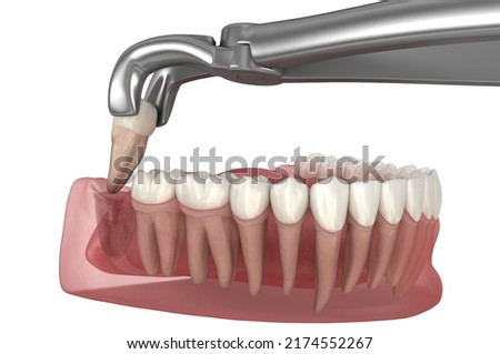 Extraction of wisdom tooth. Medically accurate tooth 3D illustration.