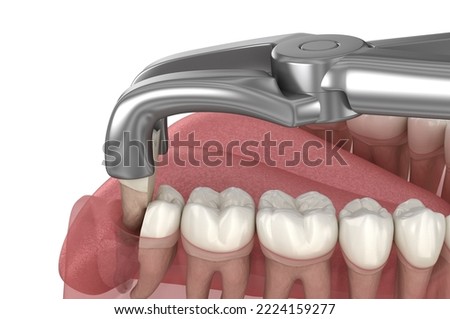 Extraction of wisdom tooth. Medically accurate tooth 3D illustration.