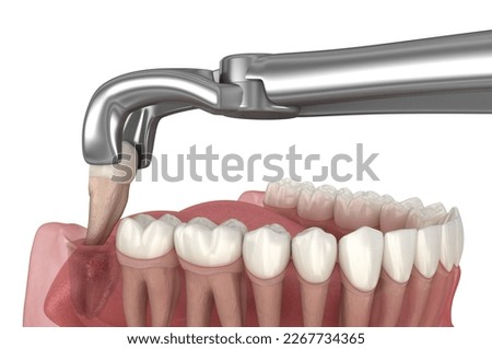 Extraction of wisdom tooth. Medically accurate tooth 3D illustration.