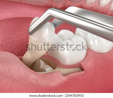 Extraction of wisdom tooth. Medically accurate tooth 3D illustration.