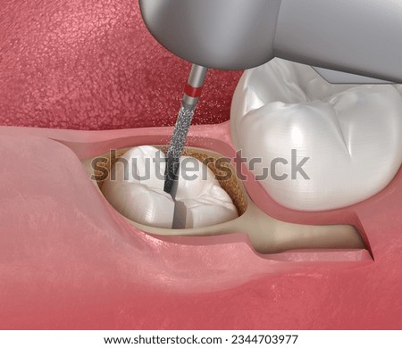 Extraction of wisdom tooth. Medically accurate tooth 3D illustration.