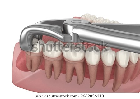Extraction of wisdom tooth. Medically accurate tooth 3D illustration.