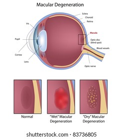 Eye Condition :  Macular Degeneration