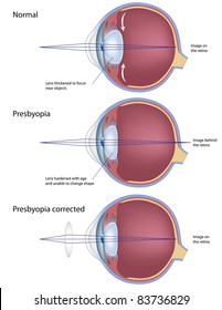  Eye Condition: Presbyopia