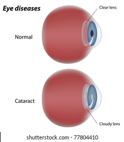 Eye Disease - Cataract