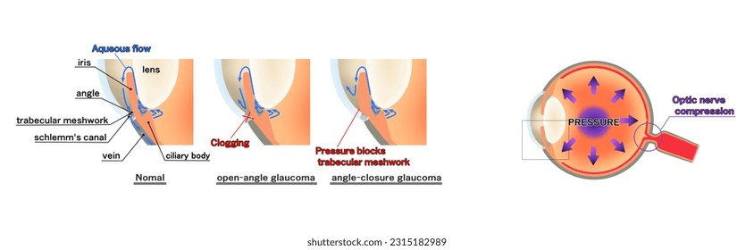 eye with glaucoma, open-angle glaucoma, angle-closure glaucoma, cross section, explanation figure