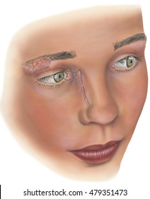 Eye - Irrigation System. Shown Are The Lacrimal Gland, Lacrimal Duct, Lacrimal Puncta, Lacrimal Canaliculus, Nasolacrimal Duct, Cornes, Pupil And Iris