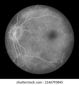 Eye Retina, Scientific Illustration Showing Optic Disk, Blood Vessels, Macula And Fovea, Ophthalmoscope View, Fluorescein Angiography