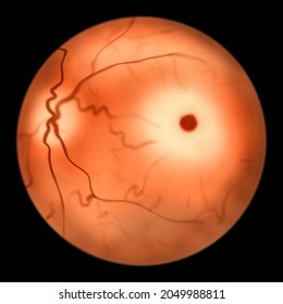 Eye Retina In Sphingolipid Storage Diseases, 3D Illustration. Macular Cherry Red Spot. Tay-Sachs Disease And Niemann Pick Disease