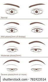 Eyelid Ptosis To Varying Degrees