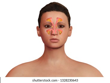 Face Woman Nasal Sinuses Inflamed Sinusitis Stock Illustration ...