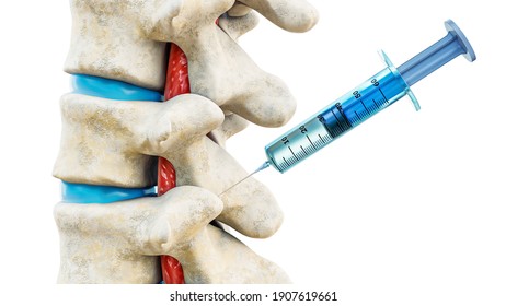 Facet Joint Injection, Therapy Against Backbone Injury Or Pain. Close-up Of Vertebrae With A Syringe Isolated On A White Background 3D Rendering Illustration. Anatomy, Medicine Concept.