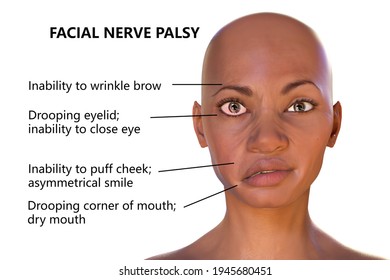 401 Facial paralysis Images, Stock Photos & Vectors | Shutterstock