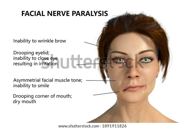 Facial Nerve Paralysis Bells Palsy 3d Stock Illustration 1891911826