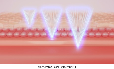 Facial Treatment With Three Shot Type Of HIFU Laser. 3D Rendering