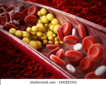 Fat cells blocking the blood flow inside human vein. 3D illustration.
