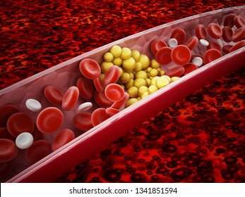 Fat cells blocking the blood flow inside human vein. 3D illustration.