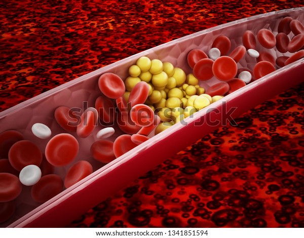 Fat cells blocking the blood flow inside\
human vein. 3D\
illustration.