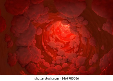 Fat hyperlipidemia or arteriosclerosis hemoglobin red blood vessel cell micro microscope inside interior human body. Embolism and cholesterol and intestinal tumors abstract concept. 3D Illustration.