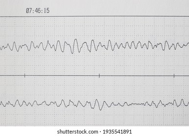Fatal Ventricular Fibrillation Recorded On A Holter EKG