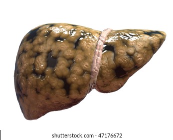 Fatty Liver