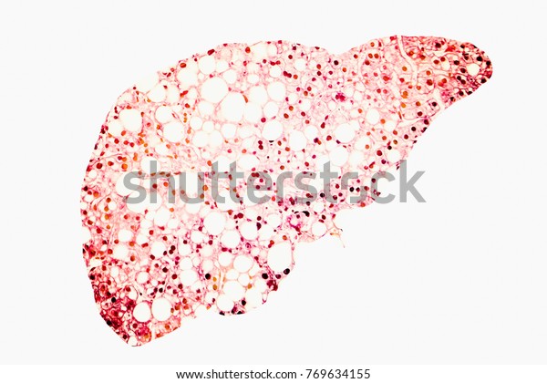 肝不全症の顕微鏡写真から作られた脂肪肝シルエットを示す脂肪肝コンセプト画像3dイラスト のイラスト素材