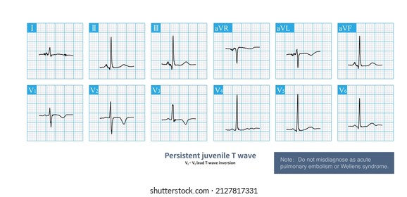 170 T wave inversion Images, Stock Photos & Vectors | Shutterstock