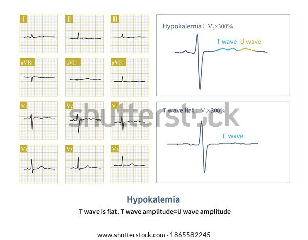 Female 33 Years Old Clinically Diagnosed Stock Illustration 1865582245 ...