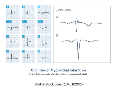 63 Pathological q wave Images, Stock Photos & Vectors | Shutterstock