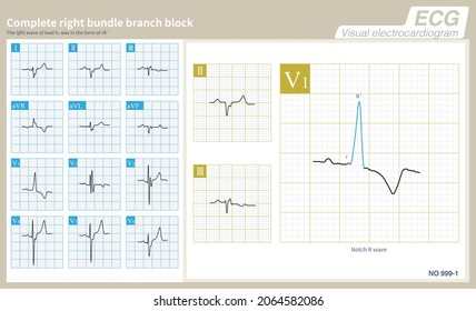 147 Sinus arrest Images, Stock Photos & Vectors | Shutterstock