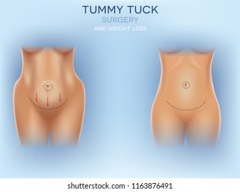 Female body correction before and after surgery and weight loss colorful illustration on a light blue background