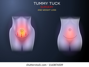 Female body correction before and after surgery and weight loss colorful illustration on a dark background